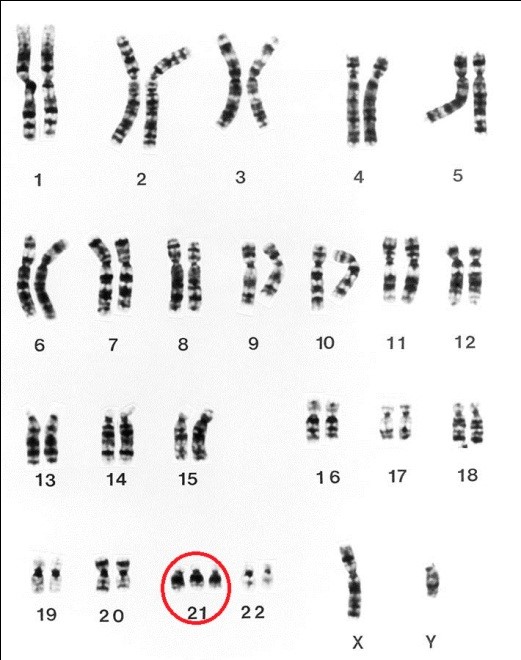 Down syndrome chromosome
